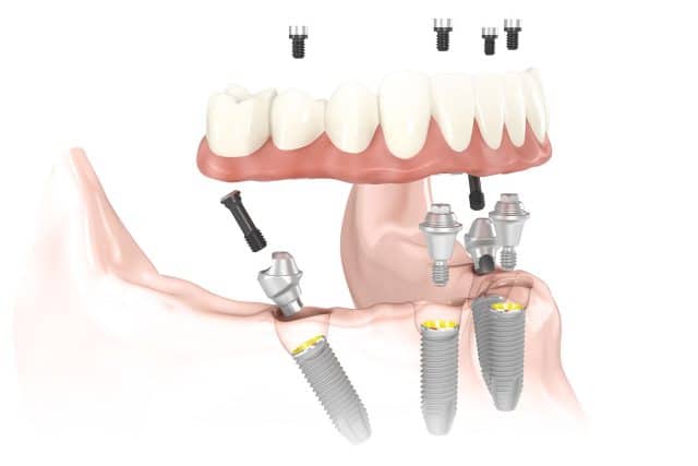 Four implants in clay model